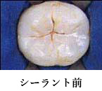 シーラント前