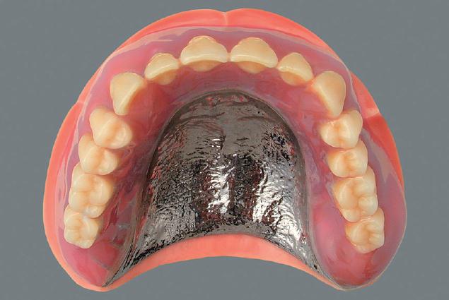 上顎金属床総義歯２.jpg