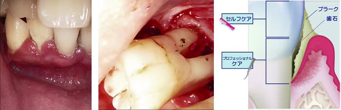 が 奥 の 腫れる 歯茎 奥歯の歯茎が痛いときの対処法3つ！考えられる原因と治療法も知っておこう