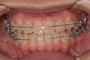 ワイヤー矯正治療中