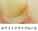 ホワイトクラスプのバネ