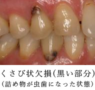 よくある症状 歯がしみる 知覚過敏 あきる野市の歯医者あきる歯科 インプラント 矯正 歯科用ct設置